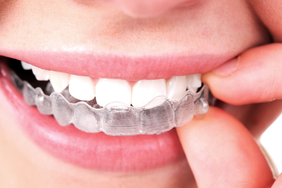 invisalign auckland cost